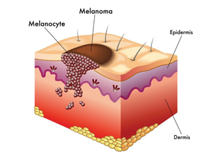 A mole is a natural formation, all of which can be removed by using Skincell Pro