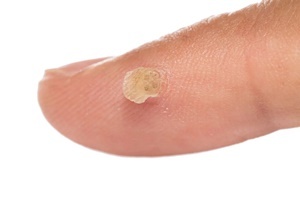 A wart is a skin disease which is an effective way of fighting Skincell Pro